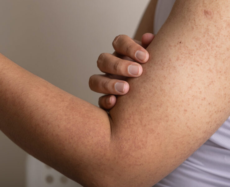 Creams for "Chicken Skin", aka Keratosis Pilaris