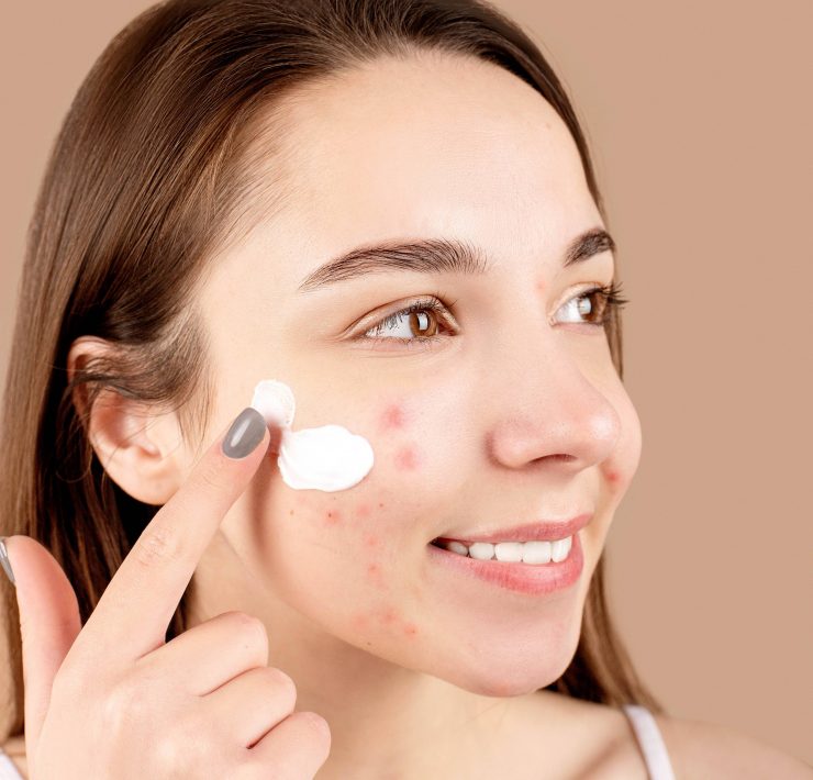 best-acne-products-sensitive-skin