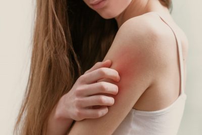 What Is the Best Cream to Stop Itching Skin?