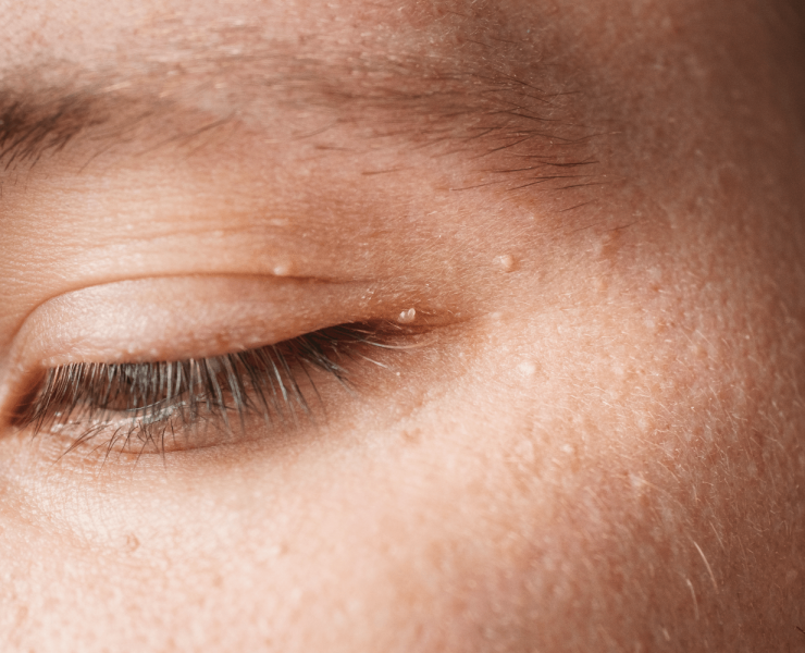 How to Prevent Milia Bumps: 3 Simple Tips