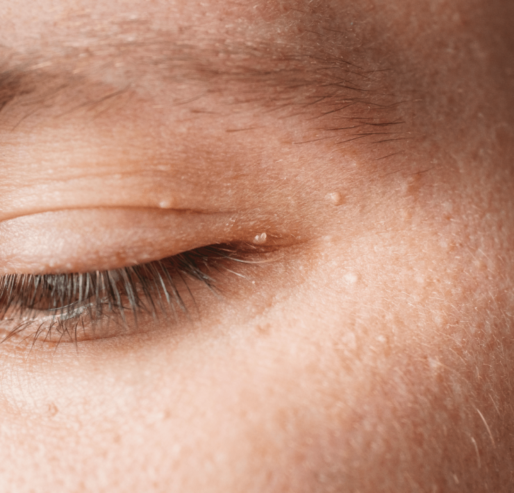 How to Prevent Milia Bumps: 3 Simple Tips