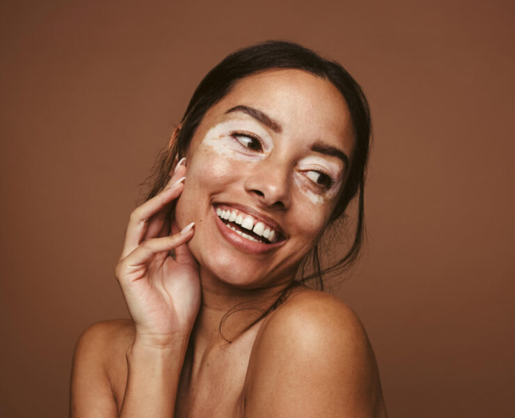 What is Vitiligo, & How Can You Manage It?