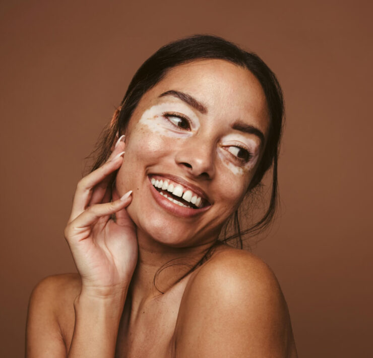 What is Vitiligo, & How Can You Manage It?
