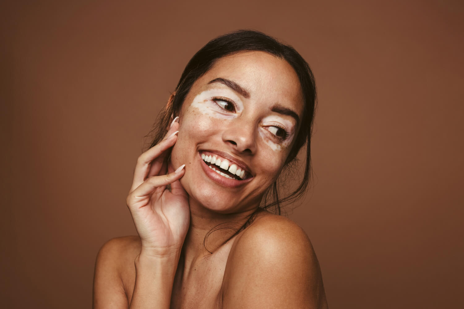 What is Vitiligo, & How Can You Manage It?