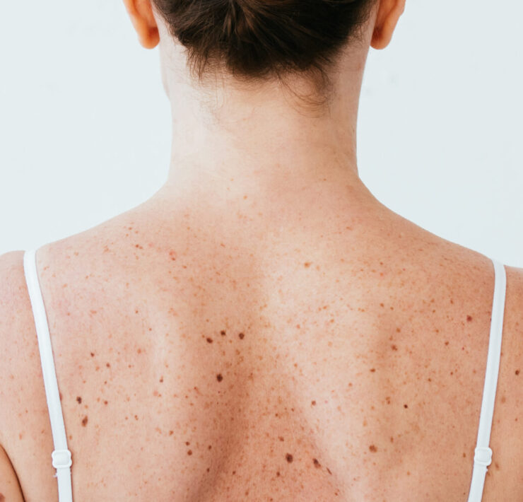 Pimples on Your Back? It's Probably Bacne