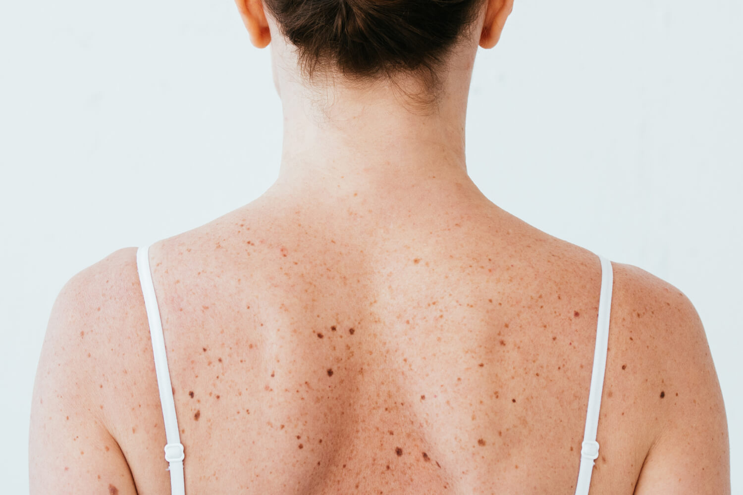 How to Get Rid of Back Acne:15 Best Tips for Bacne in 2024