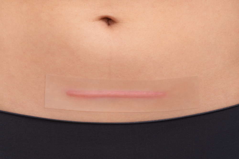 Hansaplast Scar Reducer Self-Adhesive Patches